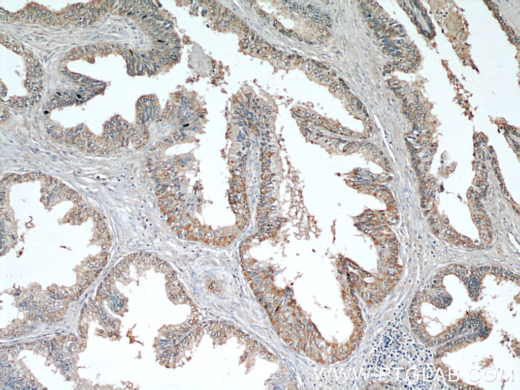 IHC staining of human prostate hyperplasia using 17003-1-AP