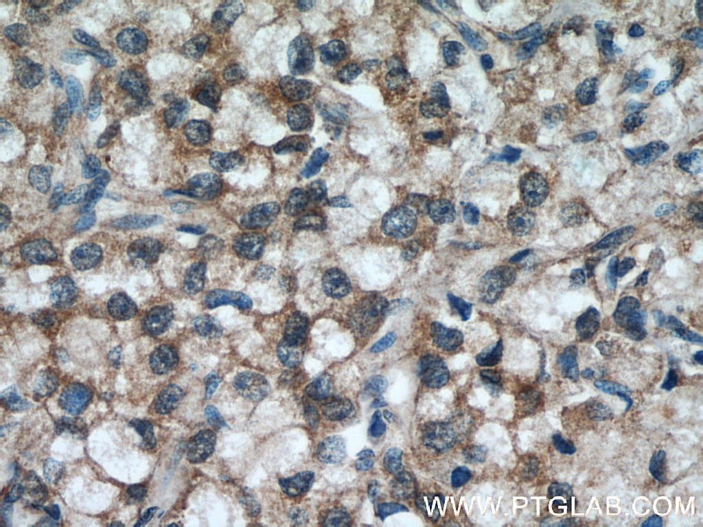 IHC staining of human prostate cancer using 17003-1-AP
