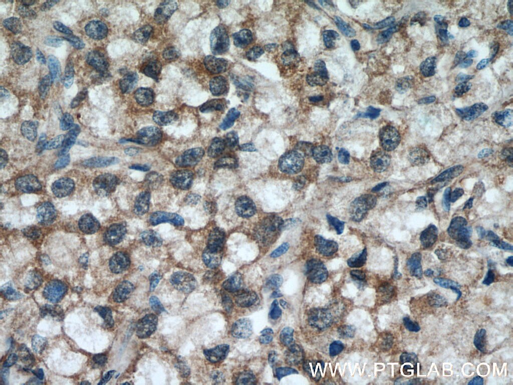 Immunohistochemistry (IHC) staining of human prostate cancer tissue using ODC1 Polyclonal antibody (17003-1-AP)