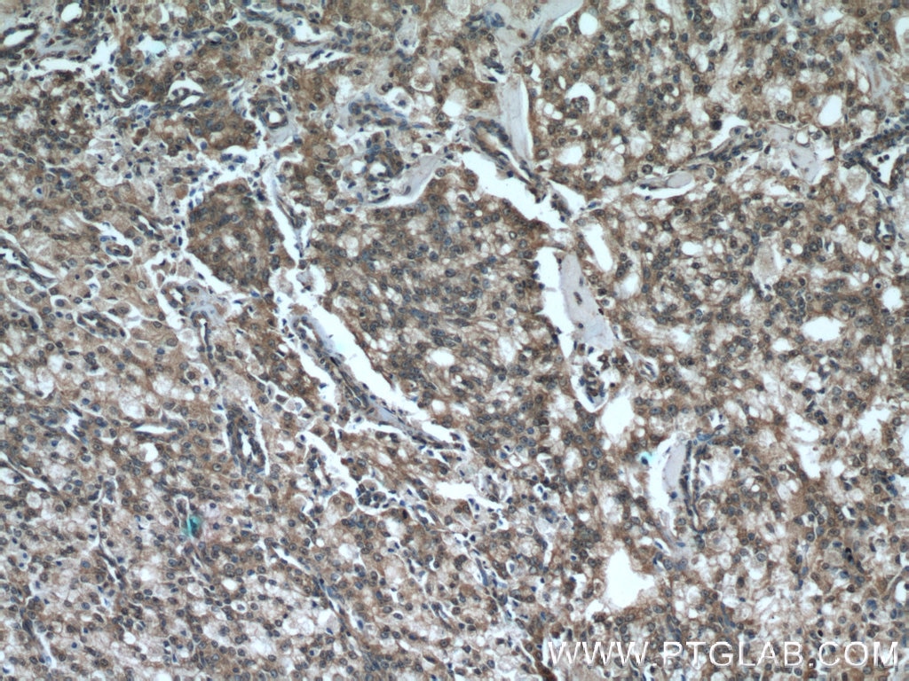 IHC staining of human prostate cancer using 17003-1-AP