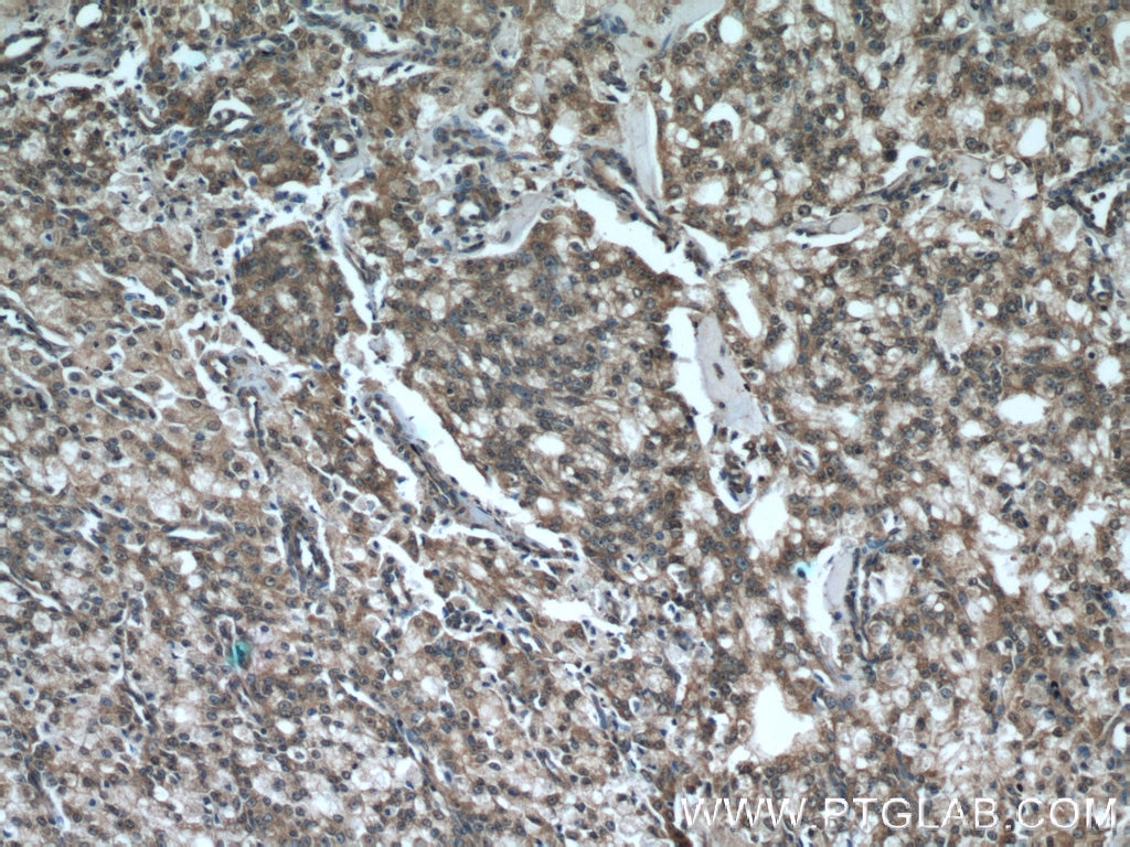 Immunohistochemistry (IHC) staining of human prostate cancer tissue using ODC1 Polyclonal antibody (17003-1-AP)