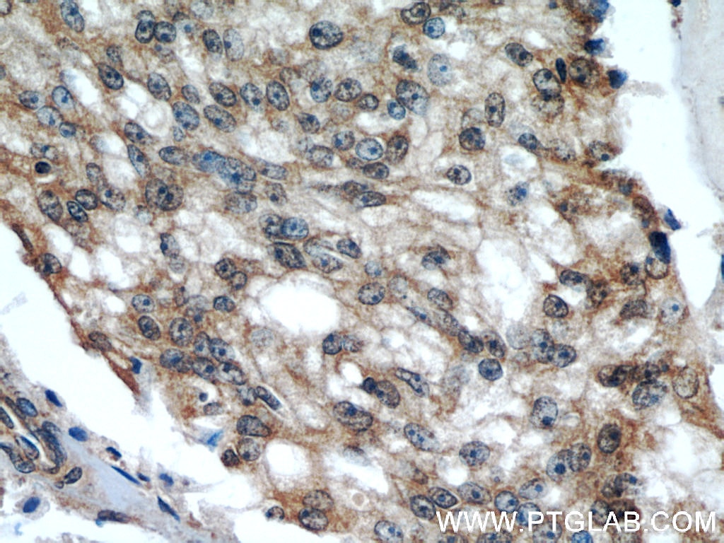 Immunohistochemistry (IHC) staining of human prostate cancer tissue using ODC1 Polyclonal antibody (17003-1-AP)