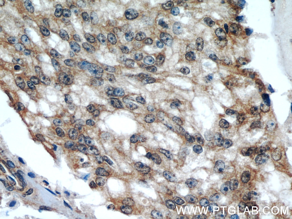 IHC staining of human prostate cancer using 17003-1-AP