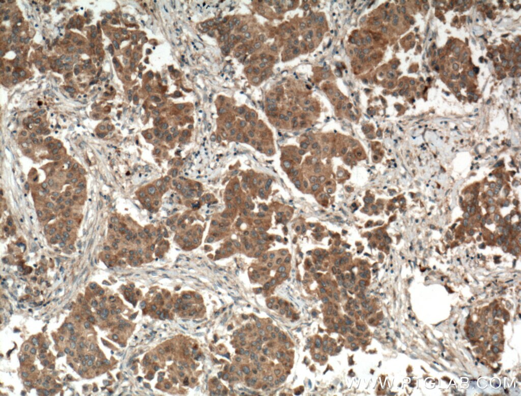 Immunohistochemistry (IHC) staining of human breast cancer tissue using ODF2 Polyclonal antibody (12058-1-AP)