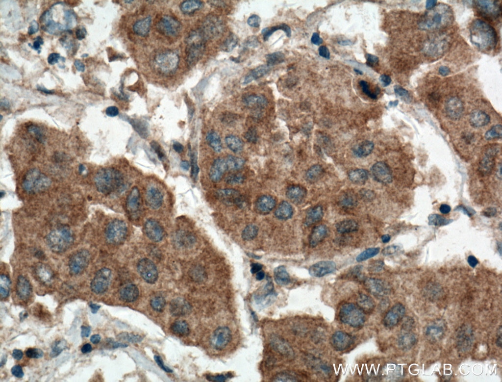 Immunohistochemistry (IHC) staining of human breast cancer tissue using ODF2 Polyclonal antibody (12058-1-AP)