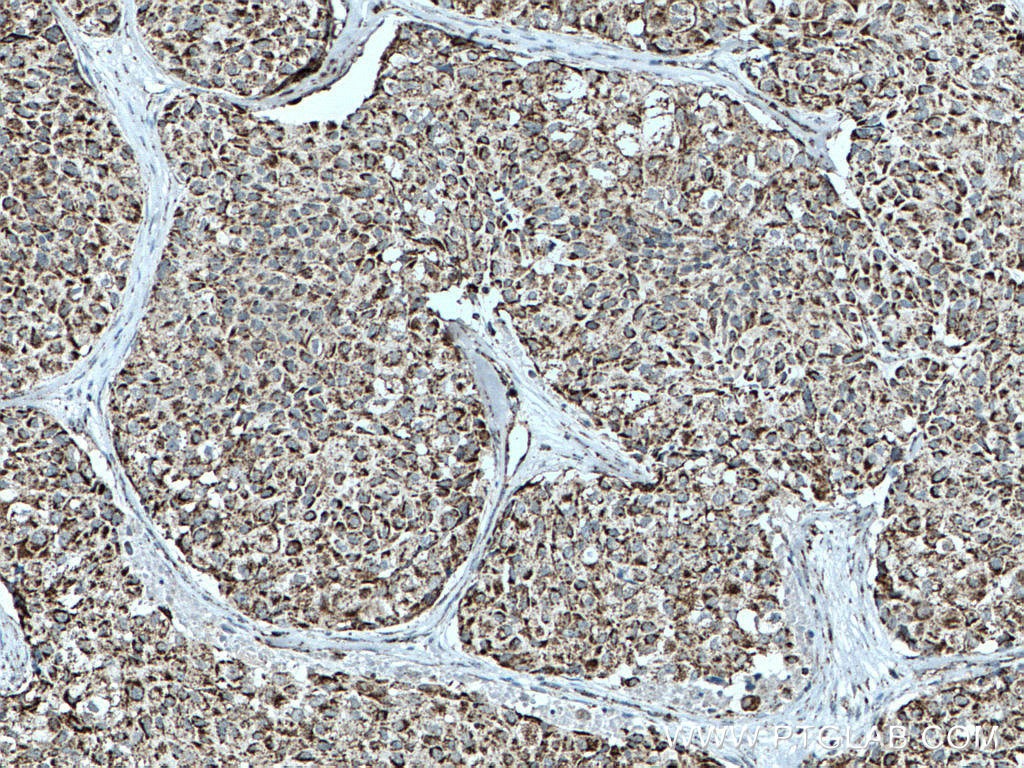 Immunohistochemistry (IHC) staining of human lung cancer tissue using OGDH Polyclonal antibody (15212-1-AP)