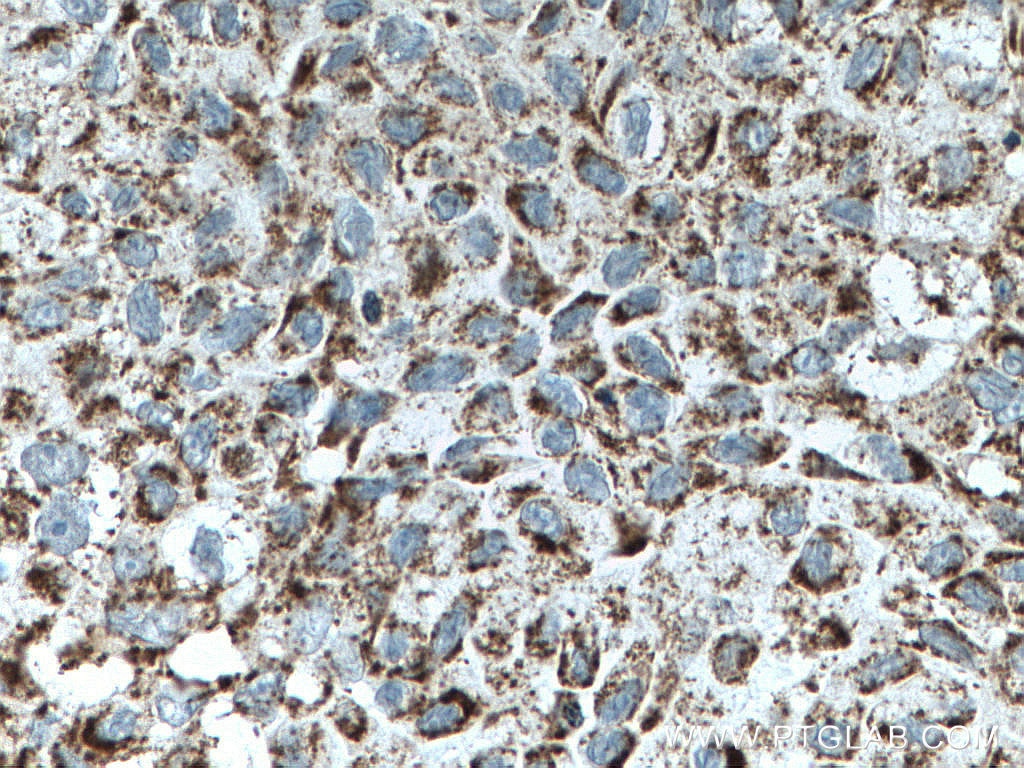 Immunohistochemistry (IHC) staining of human lung cancer tissue using OGDH Polyclonal antibody (15212-1-AP)