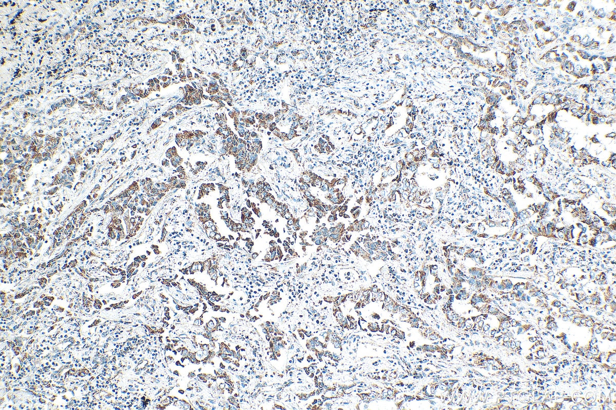 IHC staining of human lung cancer using 15212-1-AP Immunohistochemistry (IHC) staining of human lung cancer tissue using OGDH Polyclonal antibody (15212-1-AP)