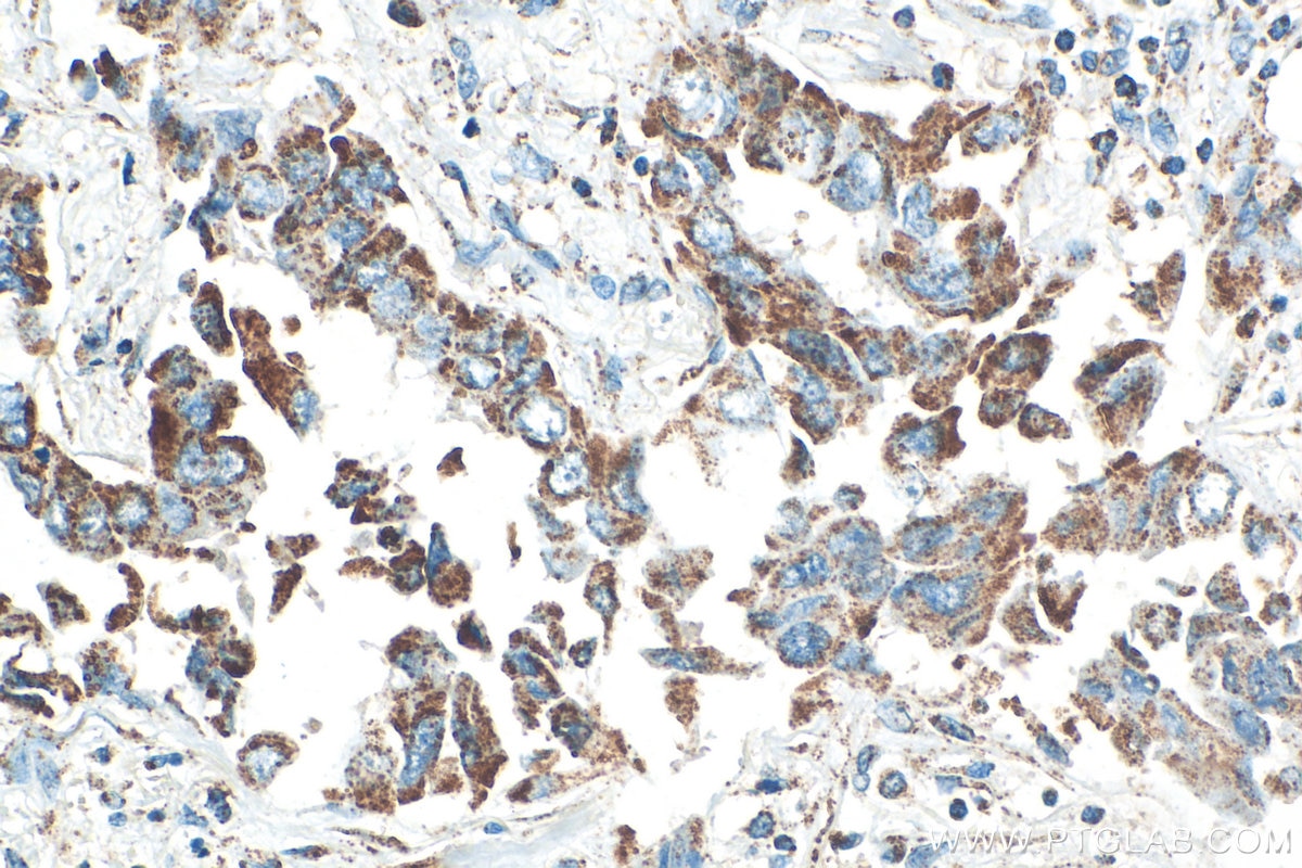 IHC staining of human lung cancer using 15212-1-AP Immunohistochemistry (IHC) staining of human lung cancer tissue using OGDH Polyclonal antibody (15212-1-AP)