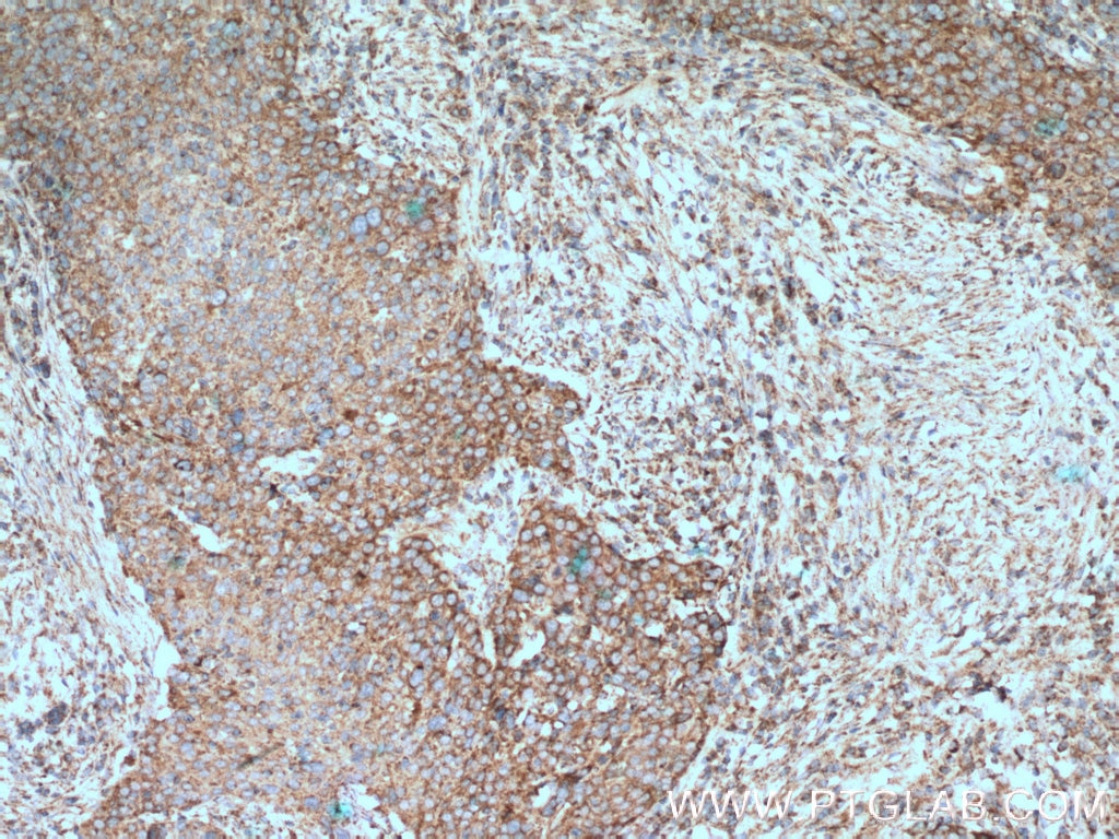 Immunohistochemistry (IHC) staining of human lung cancer tissue using OGDH Monoclonal antibody (66285-1-Ig)