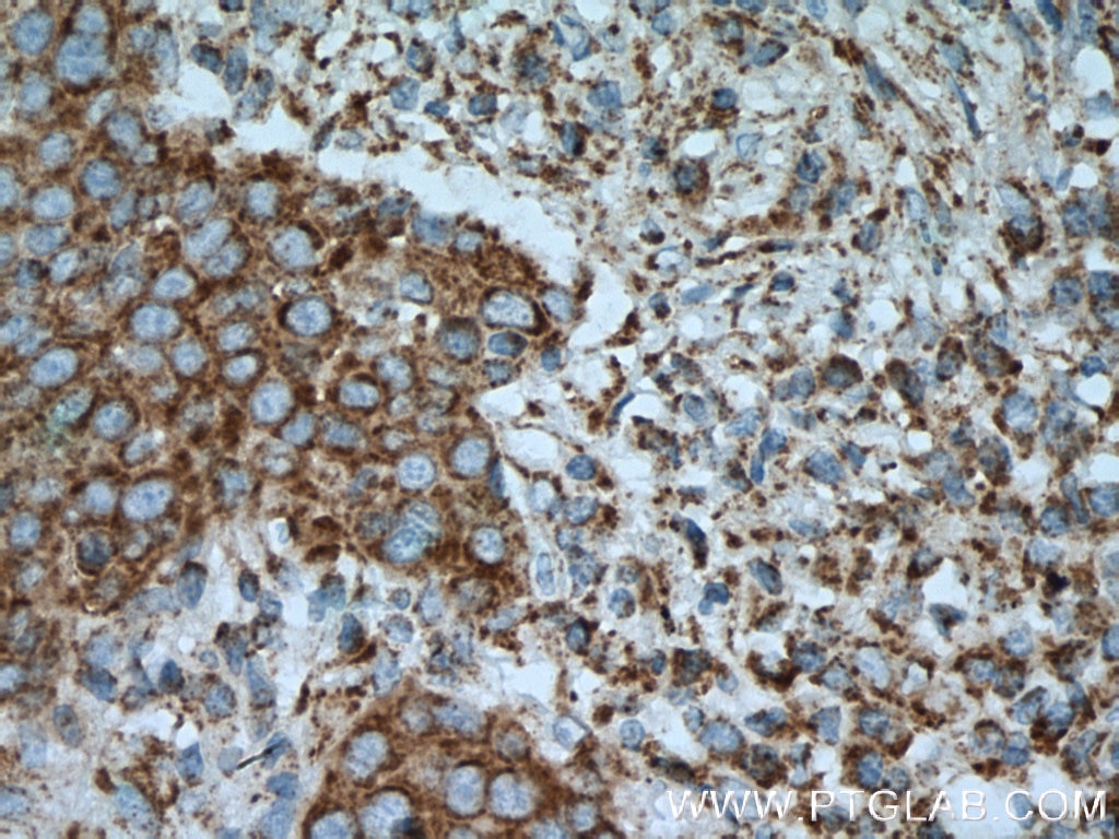 Immunohistochemistry (IHC) staining of human lung cancer tissue using OGDH Monoclonal antibody (66285-1-Ig)