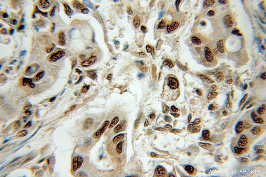 Immunohistochemistry (IHC) staining of human colon cancer tissue using OGFR Polyclonal antibody (11177-1-AP)