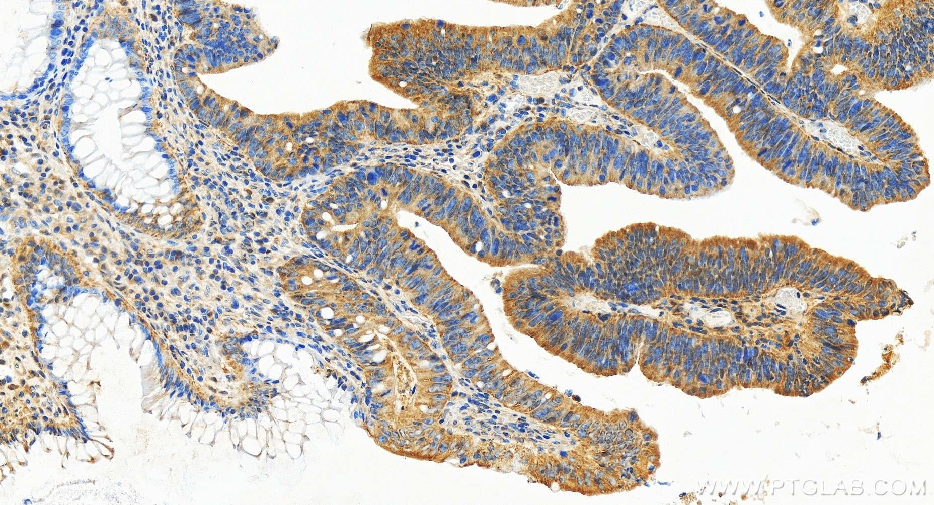 Immunohistochemistry (IHC) staining of human colon cancer tissue using OGFR Recombinant antibody (85998-1-RR)