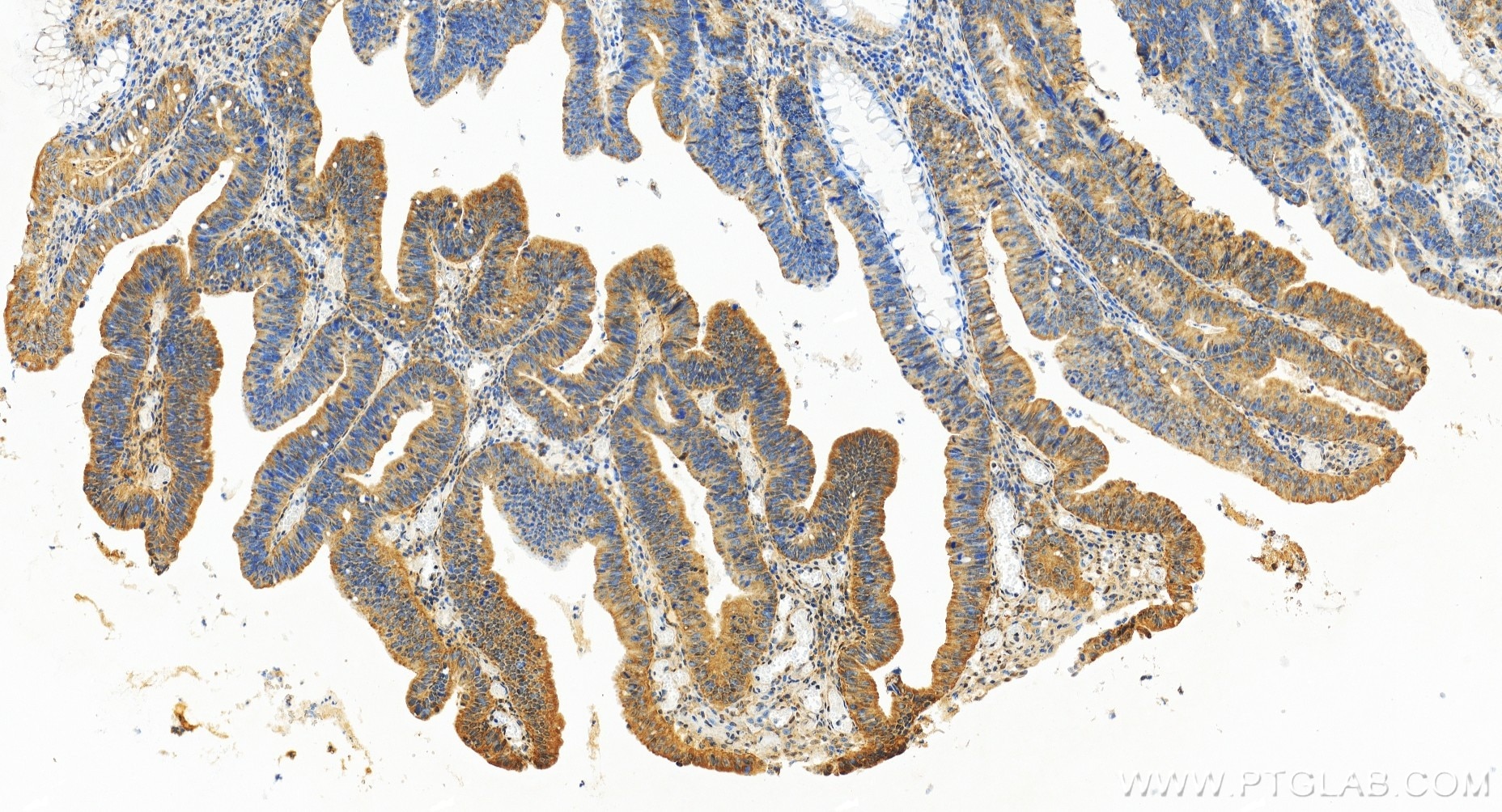 Immunohistochemistry (IHC) staining of human colon cancer tissue using OGFR Recombinant antibody (85998-1-RR)