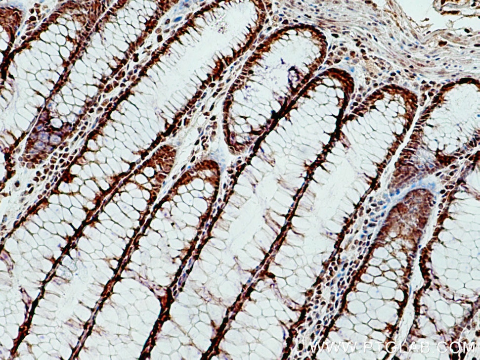 IHC staining of human colon cancer using 11576-2-AP