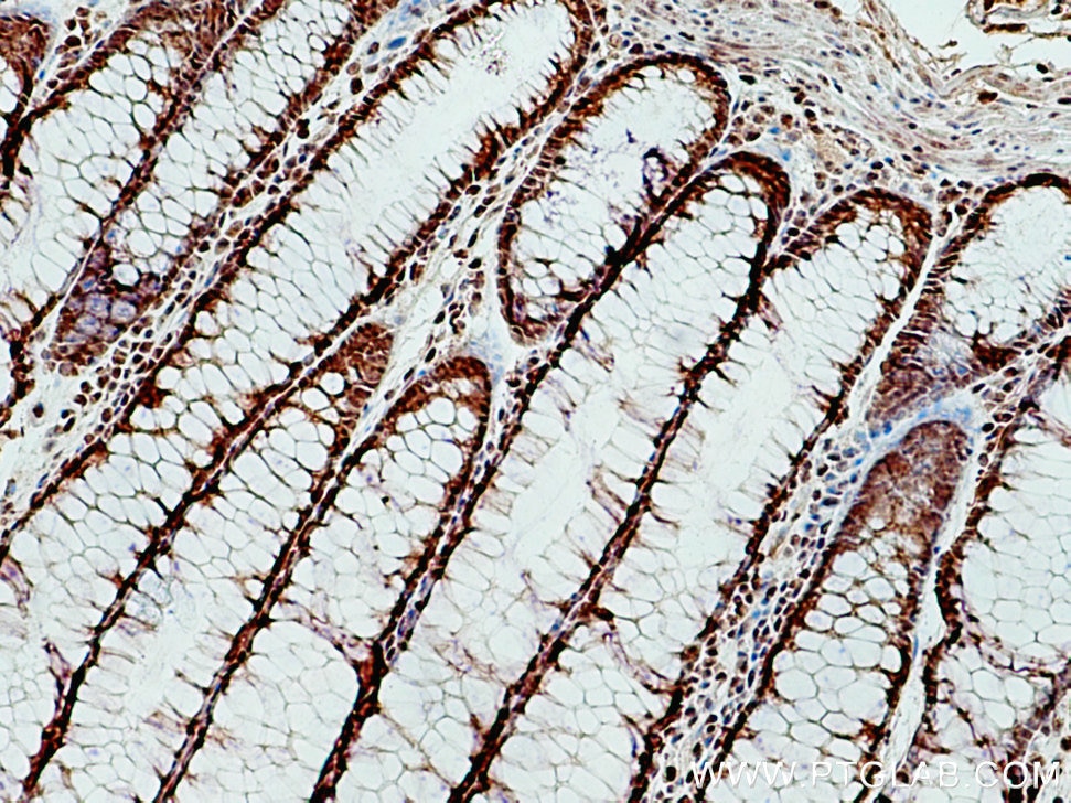 Immunohistochemistry (IHC) staining of human colon cancer tissue using OGT Polyclonal antibody (11576-2-AP)