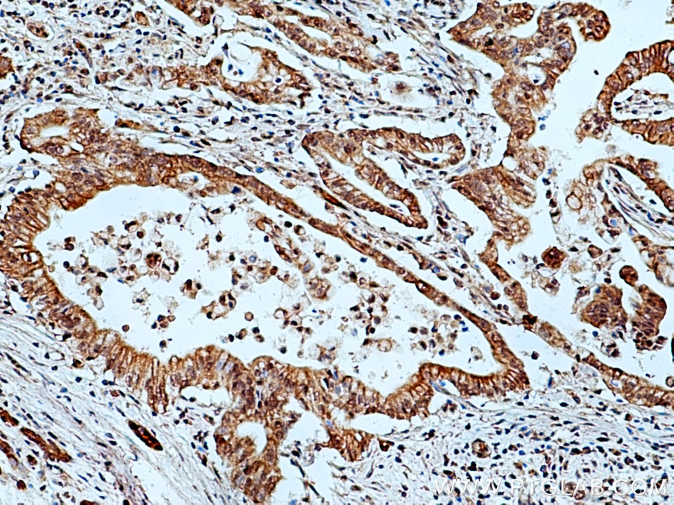Immunohistochemistry (IHC) staining of human pancreas cancer tissue using OGT Polyclonal antibody (11576-2-AP)
