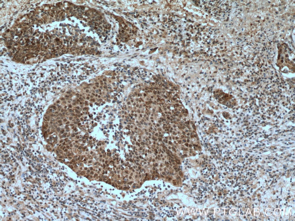 Immunohistochemistry (IHC) staining of human lung cancer tissue using OGT Polyclonal antibody (11576-2-AP)