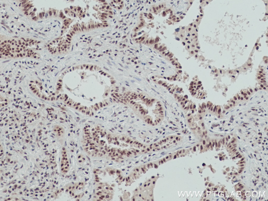 Immunohistochemistry (IHC) staining of human lung cancer tissue using OGT Monoclonal antibody (66823-1-Ig)