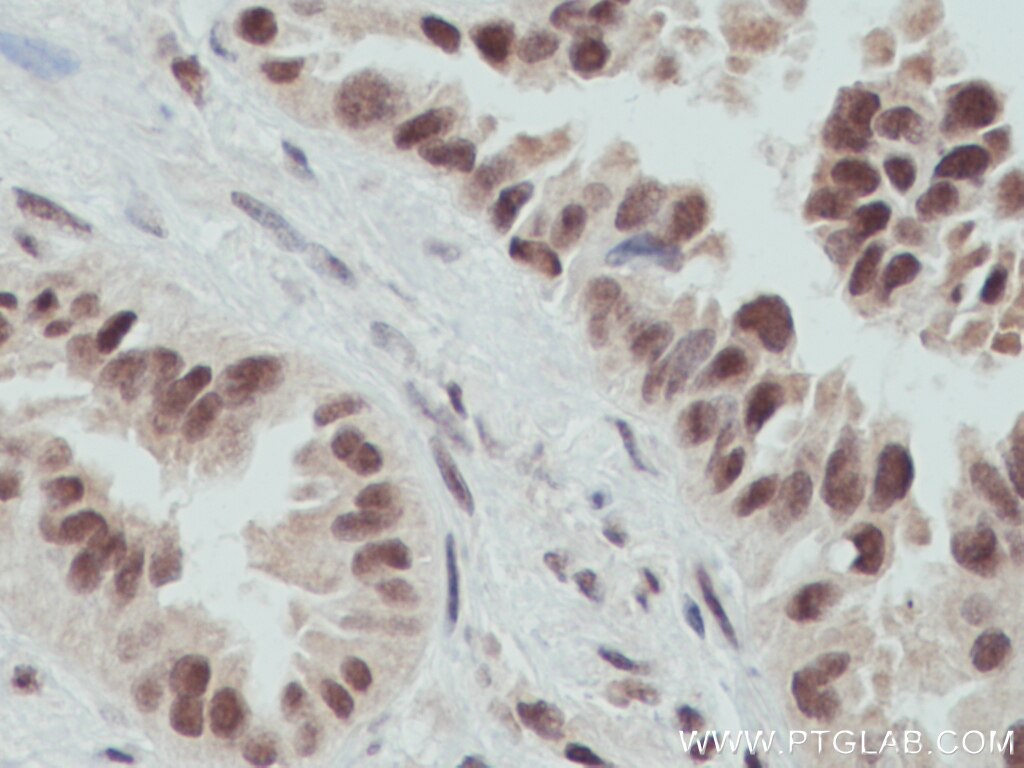 Immunohistochemistry (IHC) staining of human lung cancer tissue using OGT Monoclonal antibody (66823-1-Ig)