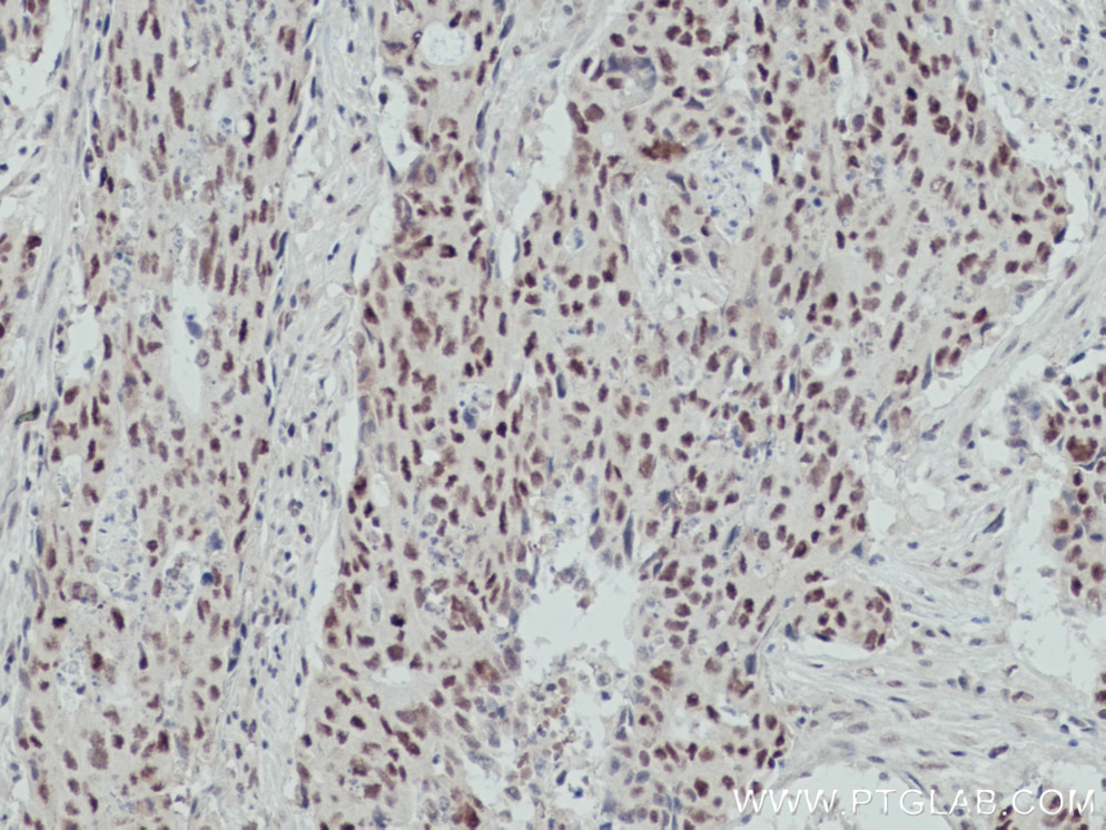 Immunohistochemistry (IHC) staining of human colon cancer tissue using OGT Monoclonal antibody (66823-1-Ig)
