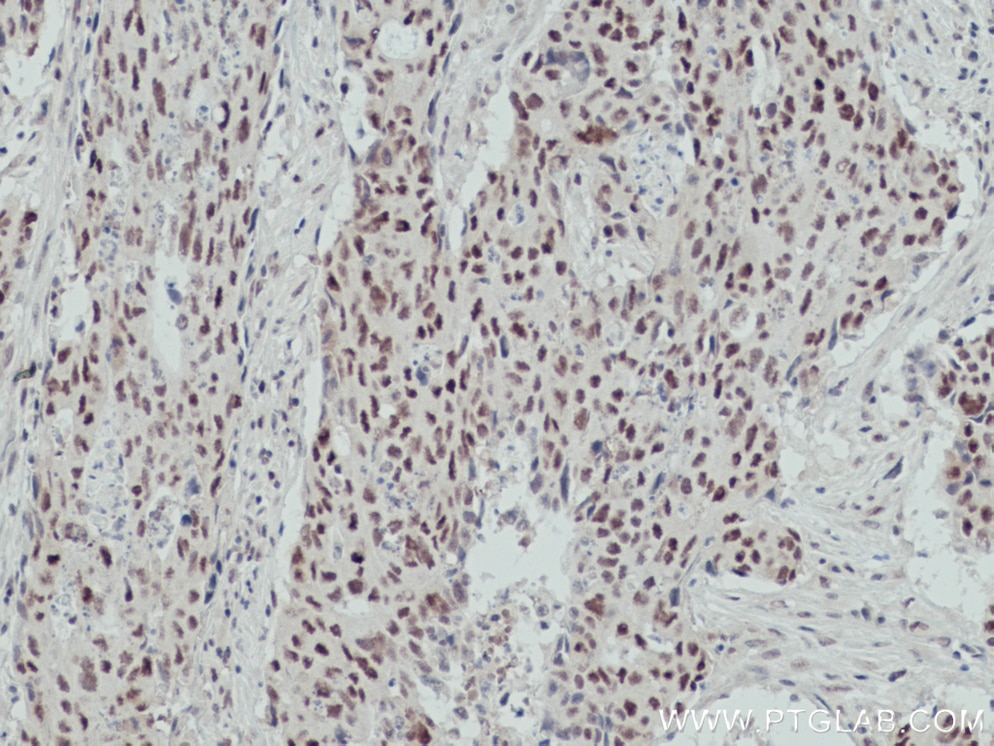 IHC staining of human colon cancer using 66823-1-Ig