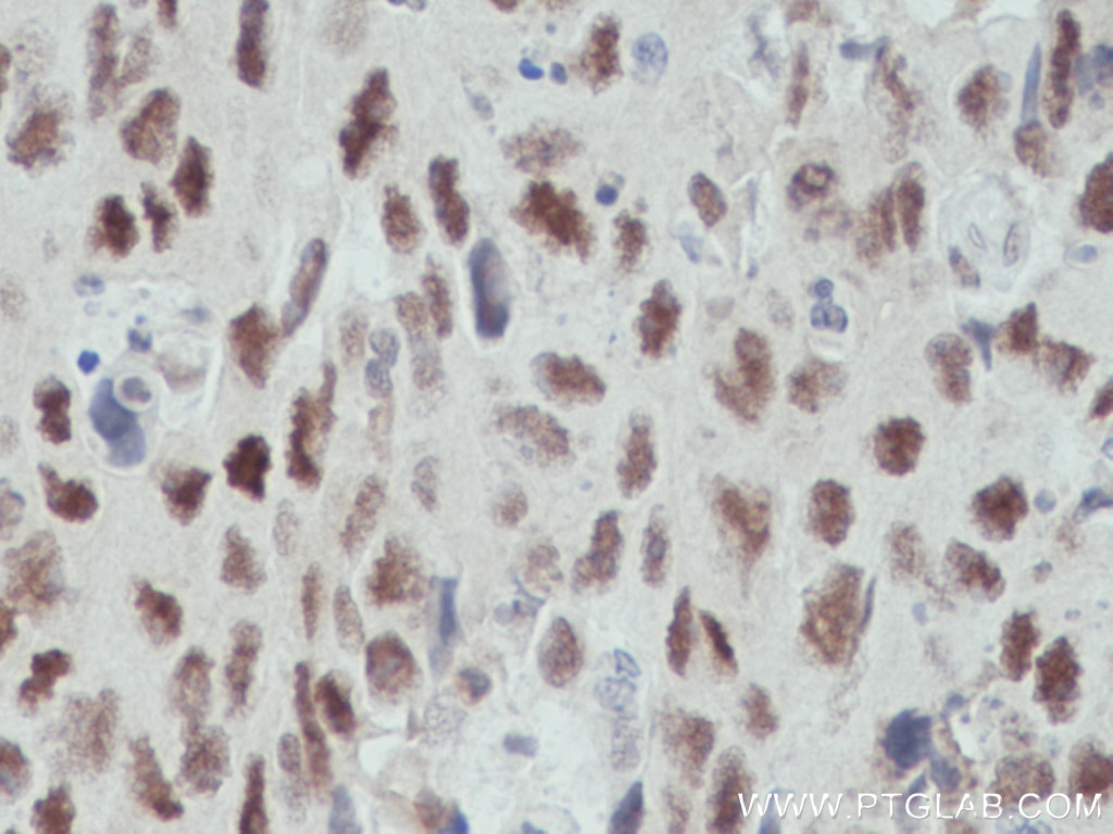 IHC staining of human colon cancer using 66823-1-Ig