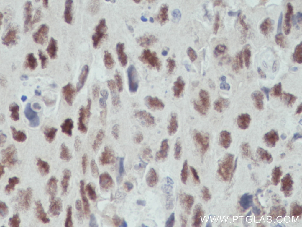 Immunohistochemistry (IHC) staining of human colon cancer tissue using OGT Monoclonal antibody (66823-1-Ig)