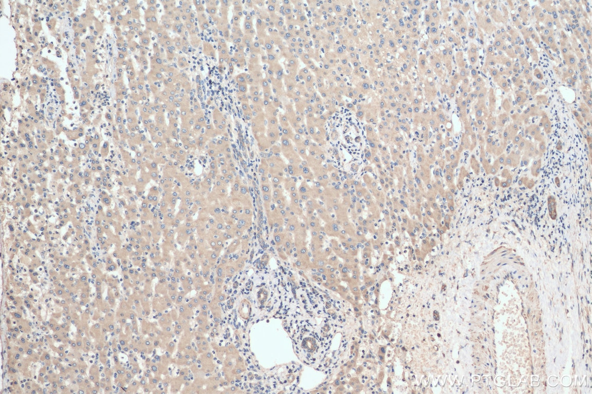 IHC staining of human liver cancer using 16371-1-AP