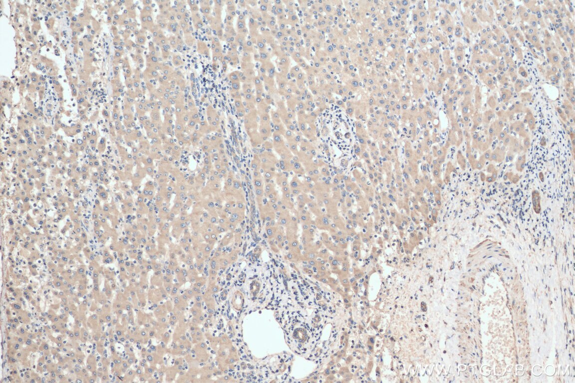 Immunohistochemistry (IHC) staining of human liver cancer tissue using GTPBP9 Polyclonal antibody (16371-1-AP)