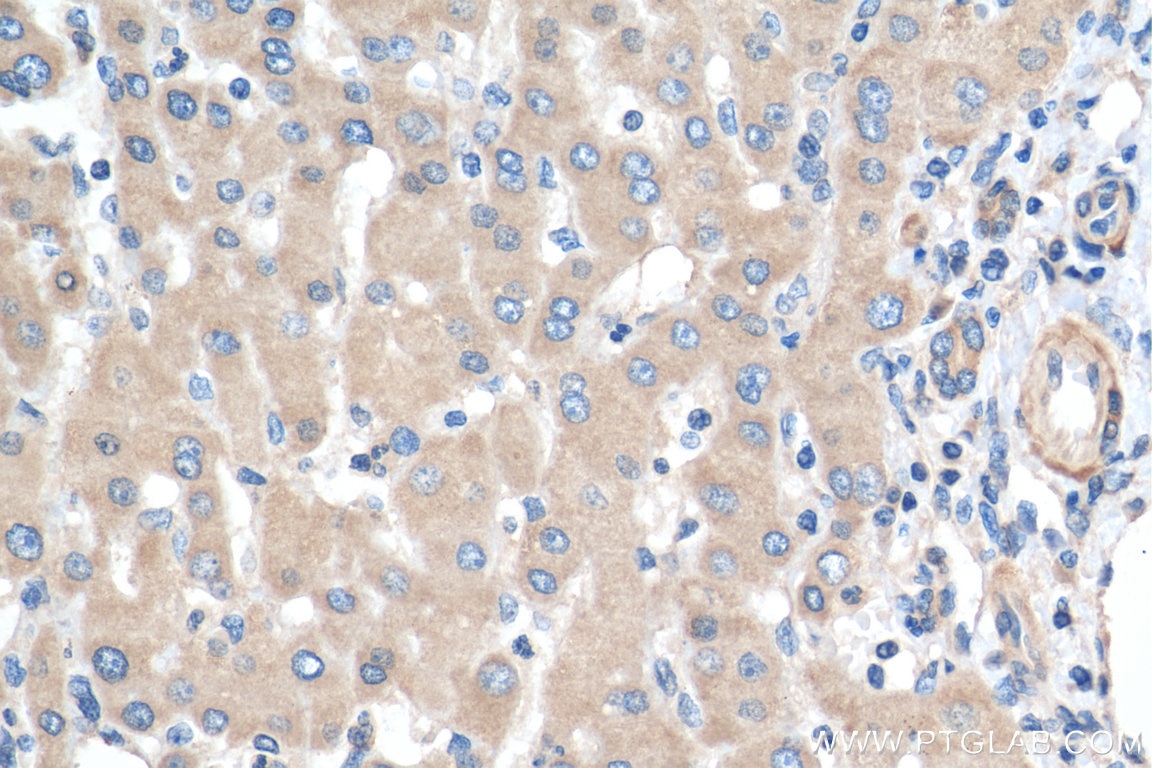 Immunohistochemistry (IHC) staining of human liver cancer tissue using GTPBP9 Polyclonal antibody (16371-1-AP)