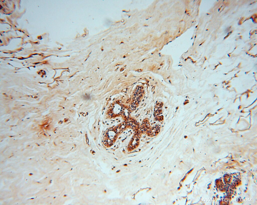 Immunohistochemistry (IHC) staining of human colon cancer tissue using GTPBP9 Polyclonal antibody (16371-1-AP)