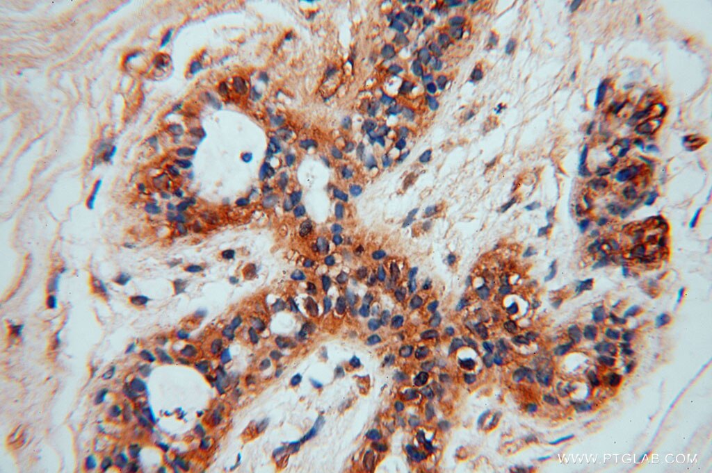 Immunohistochemistry (IHC) staining of human colon cancer tissue using GTPBP9 Polyclonal antibody (16371-1-AP)