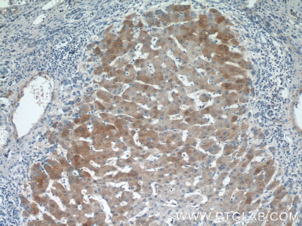Immunohistochemistry (IHC) staining of human hepatocirrhosis tissue using hIST1 Polyclonal antibody (19842-1-AP)