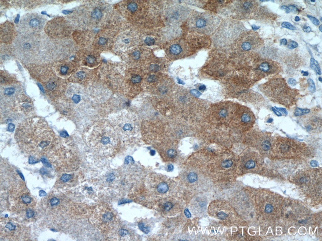 Immunohistochemistry (IHC) staining of human hepatocirrhosis tissue using hIST1 Polyclonal antibody (19842-1-AP)