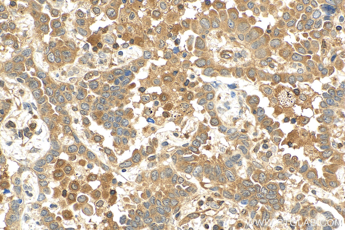 Immunohistochemistry (IHC) staining of human lung cancer tissue using hIST1 Polyclonal antibody (51002-1-AP)