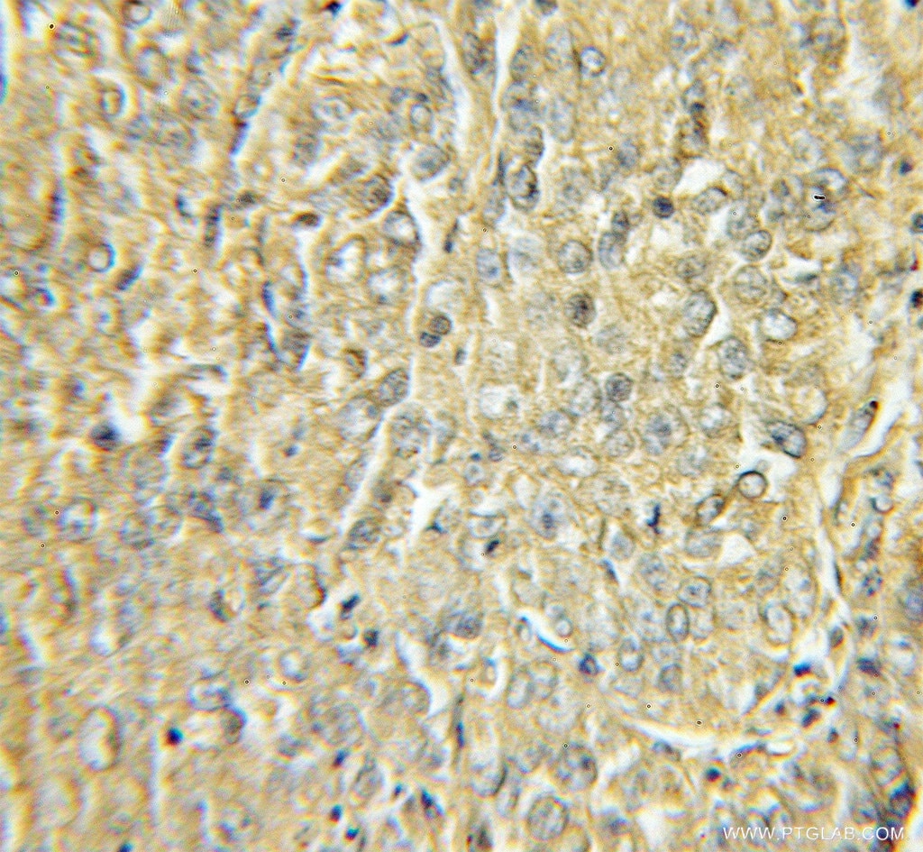 Immunohistochemistry (IHC) staining of human lung cancer tissue using OLFM1 Polyclonal antibody (10079-1-AP)