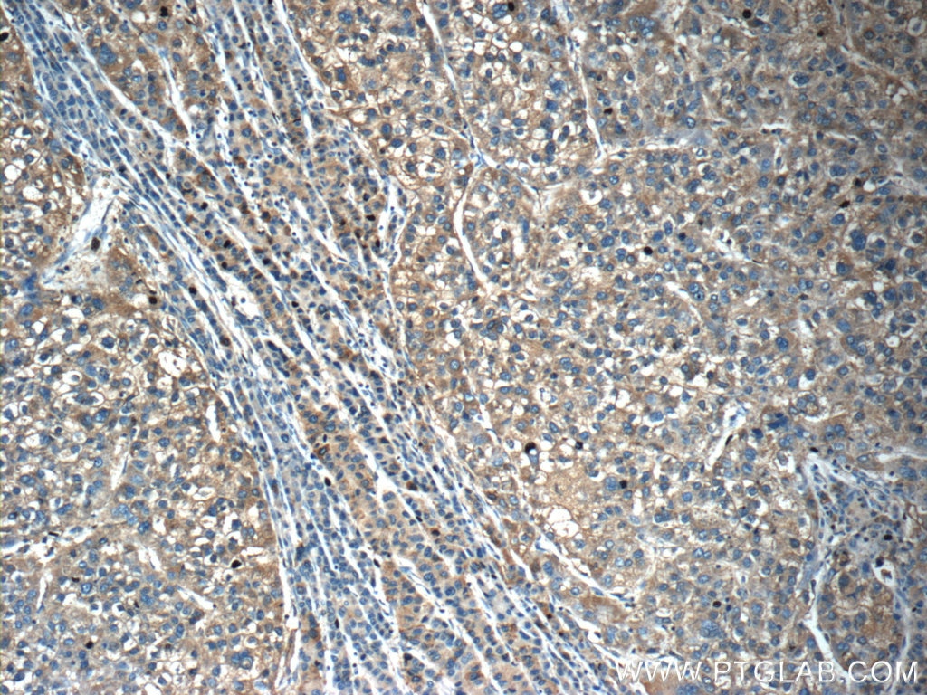 Immunohistochemistry (IHC) staining of human liver cancer tissue using OLFM3 Polyclonal antibody (12596-1-AP)