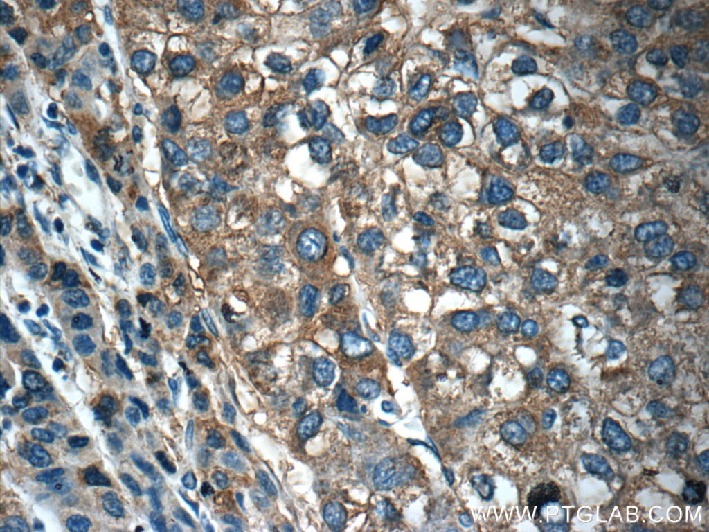 Immunohistochemistry (IHC) staining of human liver cancer tissue using OLFM3 Polyclonal antibody (12596-1-AP)