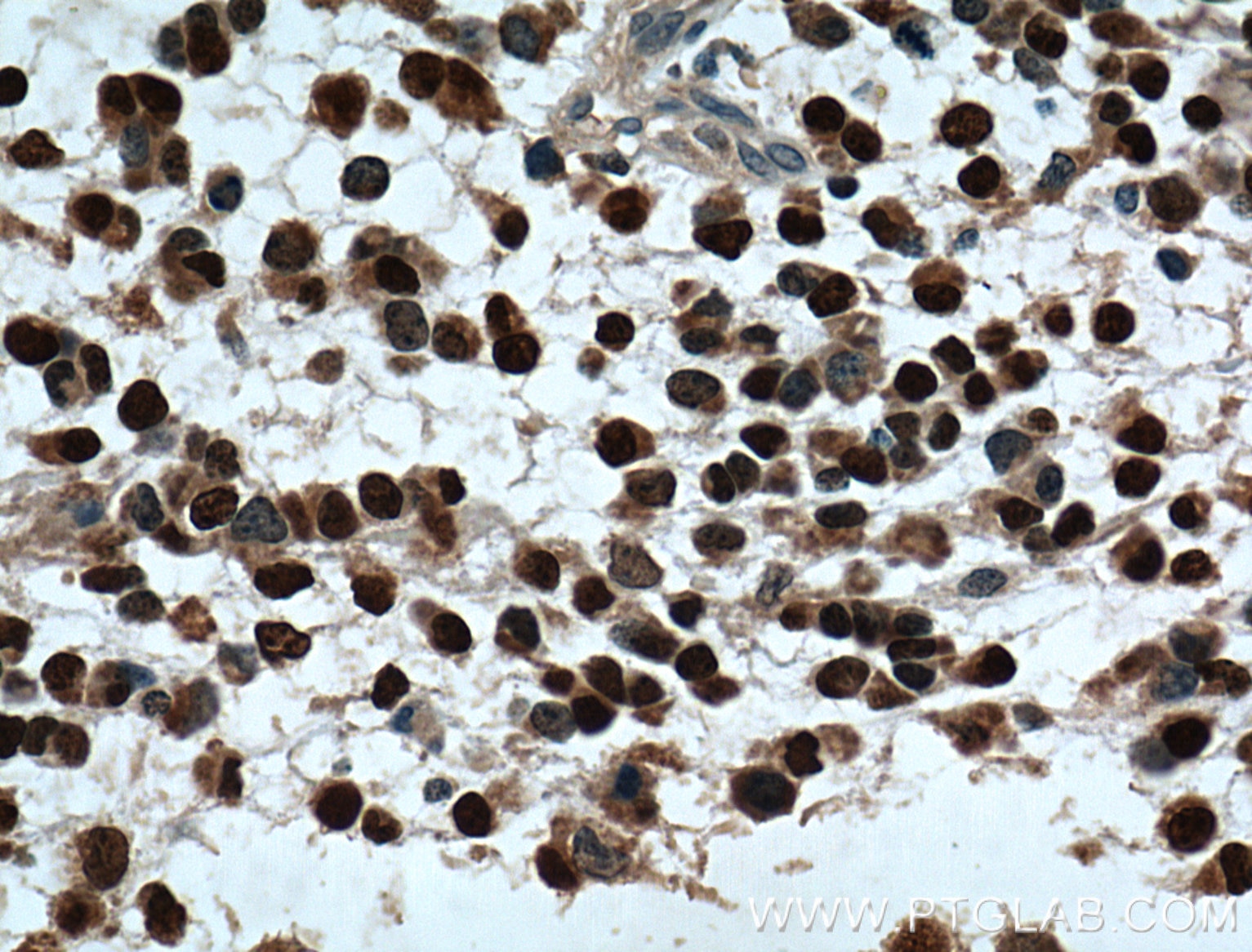 Immunohistochemistry (IHC) staining of human gliomas tissue using OLIG2 Polyclonal antibody (13999-1-AP)