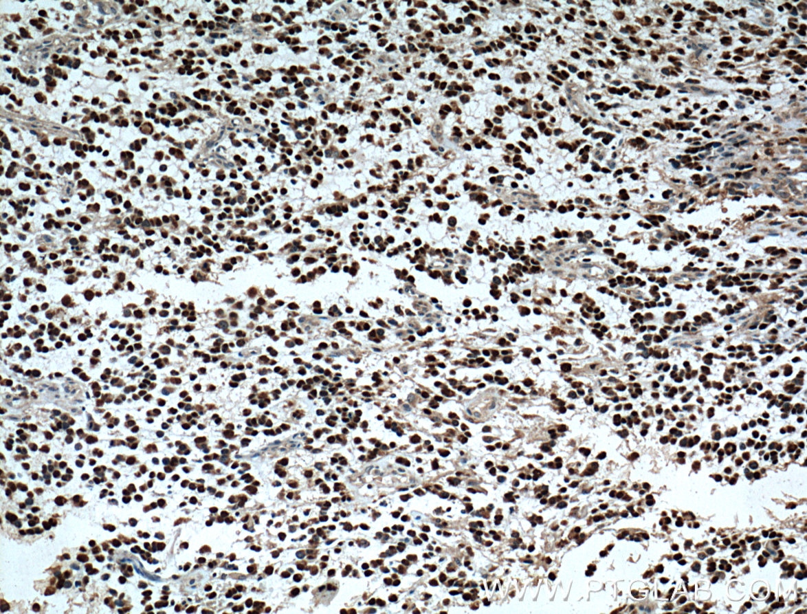 Immunohistochemistry (IHC) staining of human gliomas tissue using OLIG2 Polyclonal antibody (13999-1-AP)