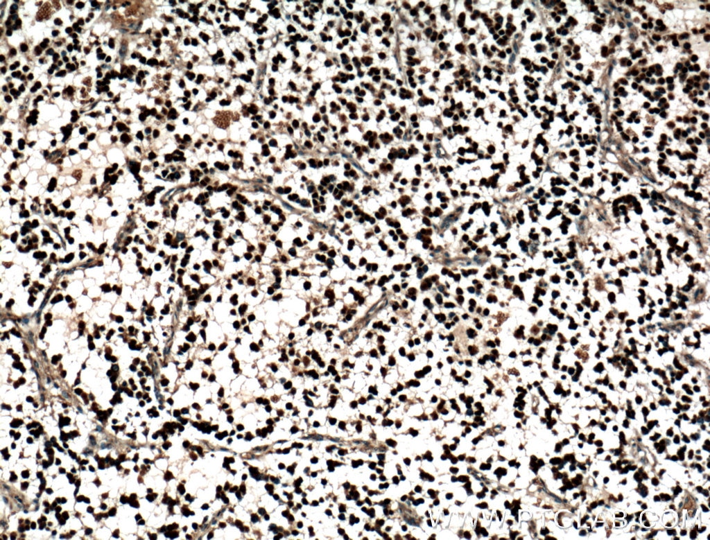 Immunohistochemistry (IHC) staining of human gliomas tissue using OLIG2 Polyclonal antibody (25754-1-AP)
