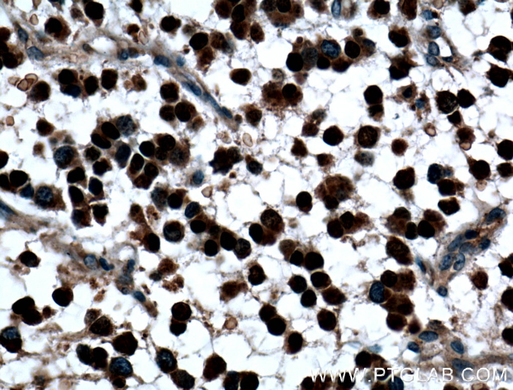 Immunohistochemistry (IHC) staining of human gliomas tissue using OLIG2 Polyclonal antibody (25754-1-AP)