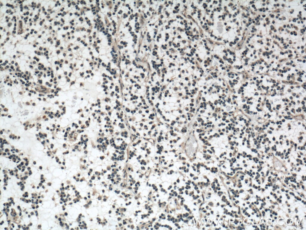 Immunohistochemistry (IHC) staining of human gliomas tissue using OLIG2 Monoclonal antibody (66513-1-Ig)