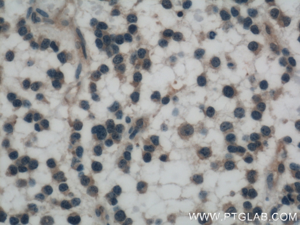 Immunohistochemistry (IHC) staining of human gliomas tissue using OLIG2 Monoclonal antibody (66513-1-Ig)