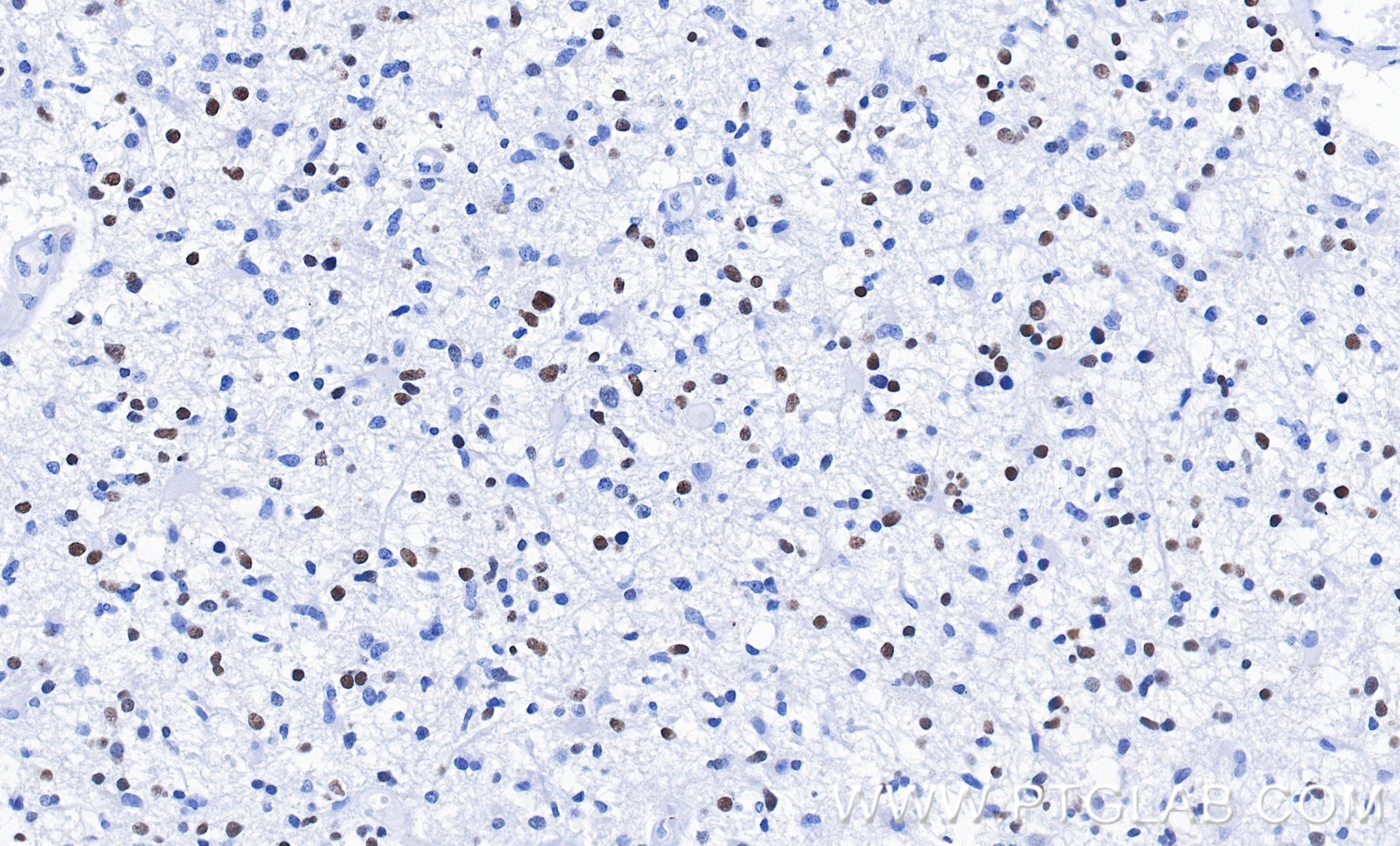 IHC staining of Human brain cancer(Astrocitoma) using 82806-7-RR (same clone as 82806-7-PBS) Immunohistochemistry (IHC) staining of Human brain cancer(Astrocitoma) using OLIG2 Recombinant monoclonal antibody (82806-7-RR)