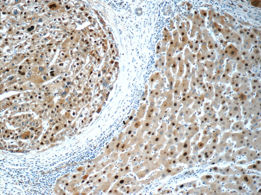 Immunohistochemistry (IHC) staining of human liver cancer tissue using ONECUT1 Polyclonal antibody (25137-1-AP)