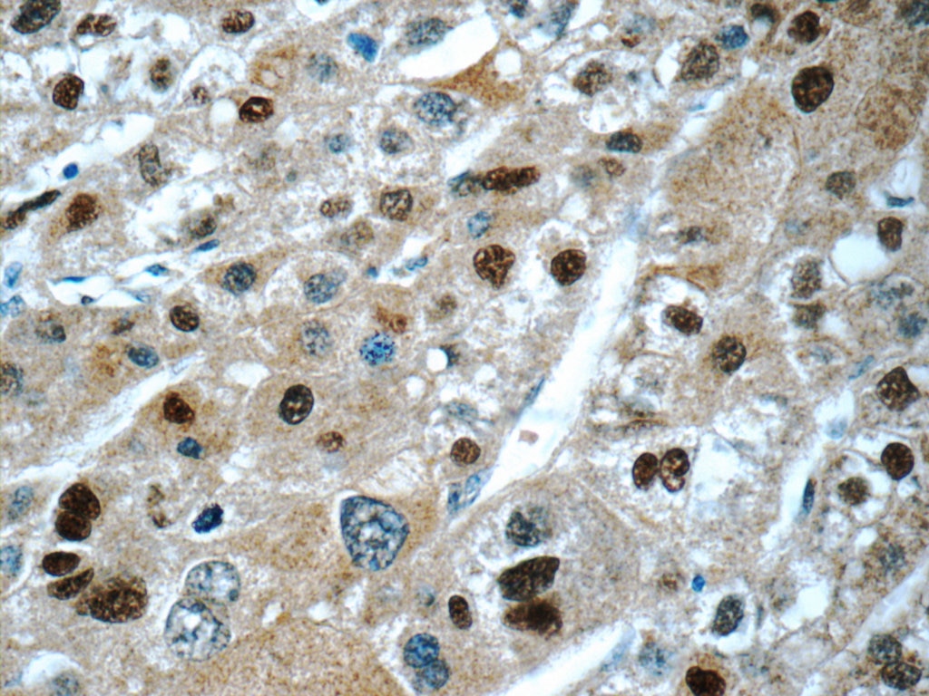 Immunohistochemistry (IHC) staining of human liver cancer tissue using ONECUT1 Polyclonal antibody (25137-1-AP)