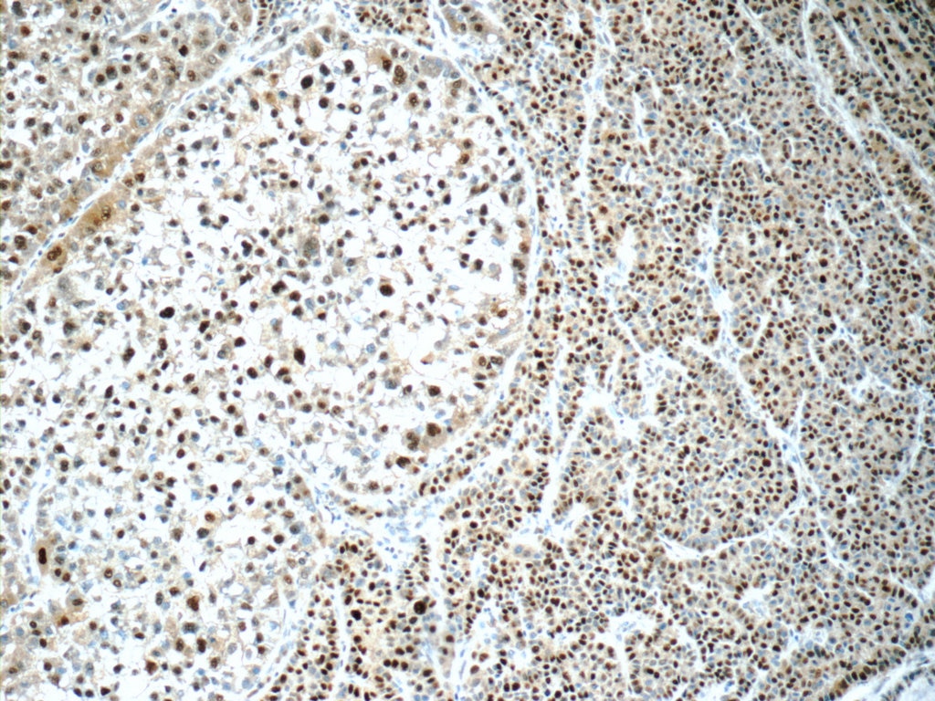 Immunohistochemistry (IHC) staining of human liver cancer tissue using ONECUT1 Polyclonal antibody (25137-1-AP)