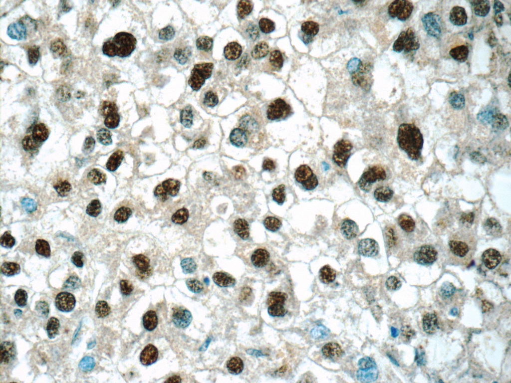 Immunohistochemistry (IHC) staining of human liver cancer tissue using ONECUT1 Polyclonal antibody (25137-1-AP)